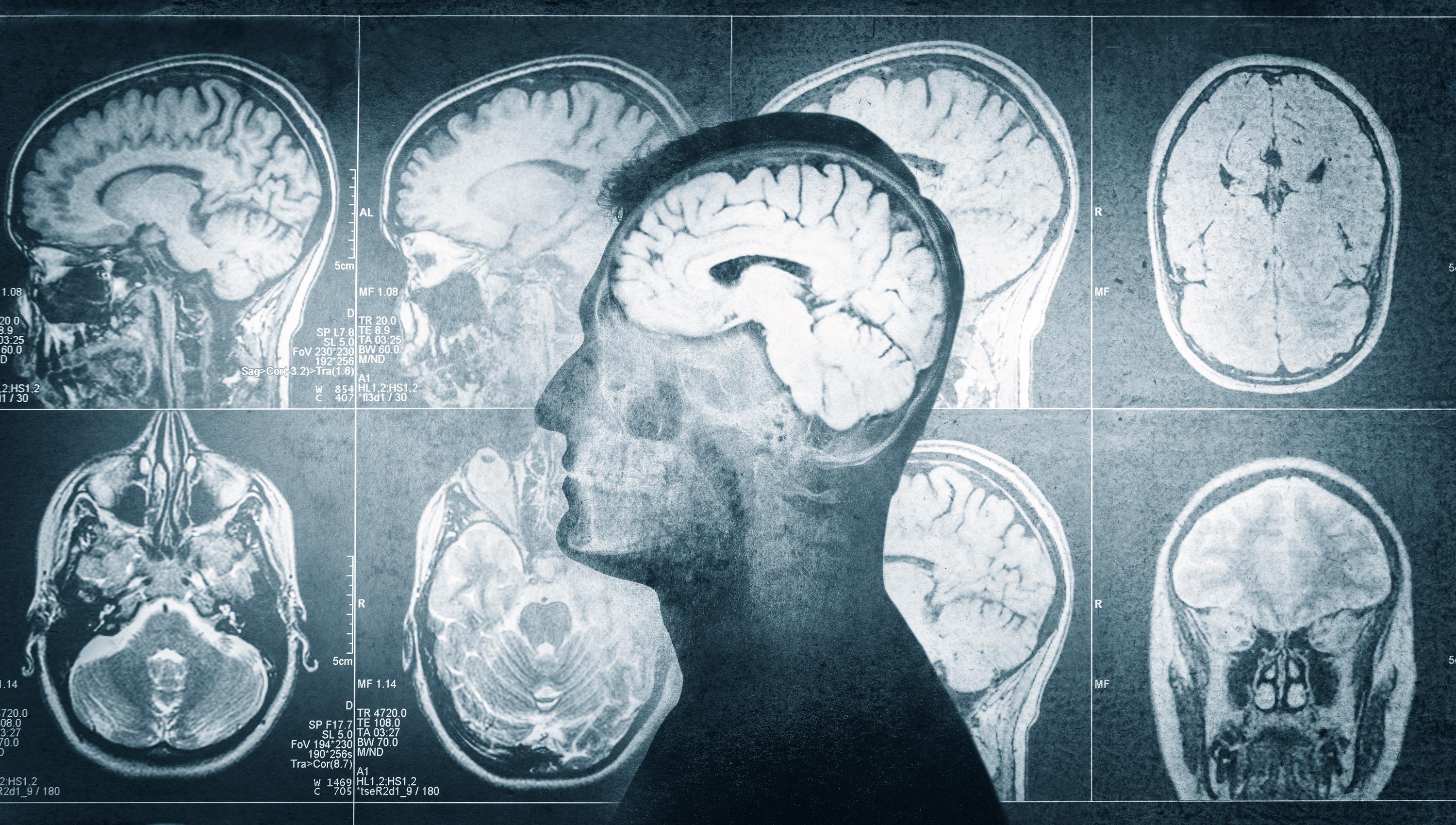 «C’est un dragon qui écrase tout sur son passage» : briser le silence autour du cancer du cerveau avec la campagne Mai en gris